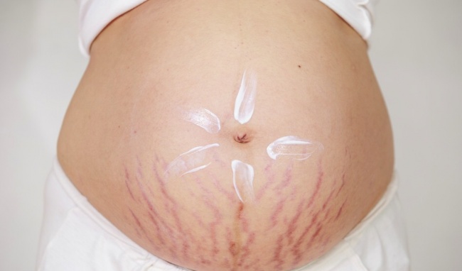 Vết rạn da - Hình ảnh minh họa